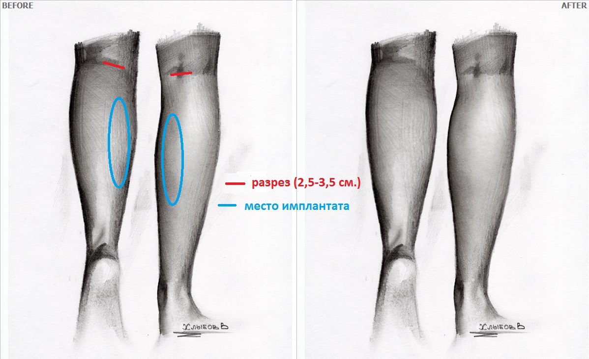 Сколько стоят голени. Круропластика голени асимметрия голени. Импланты икроножных мышц.