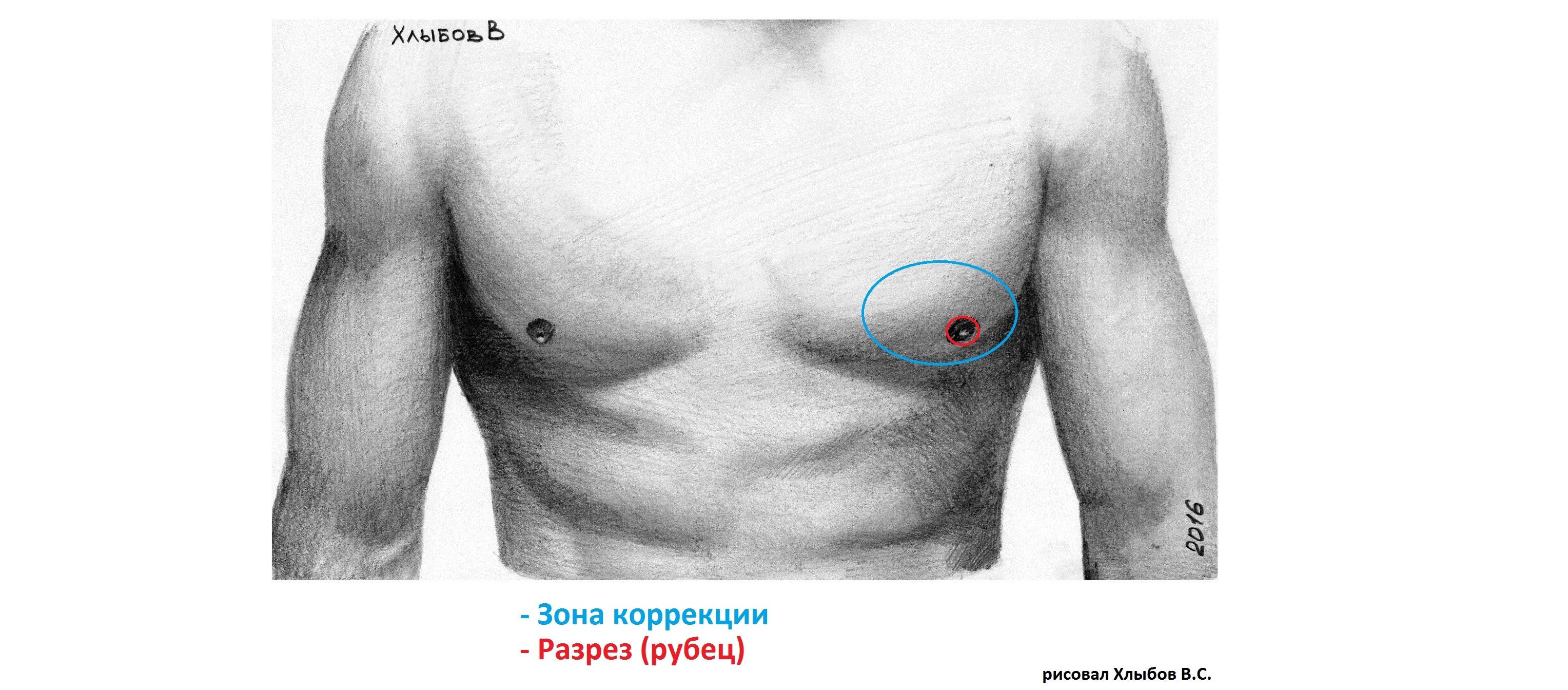 опухоль у мужчин в области груди фото 115